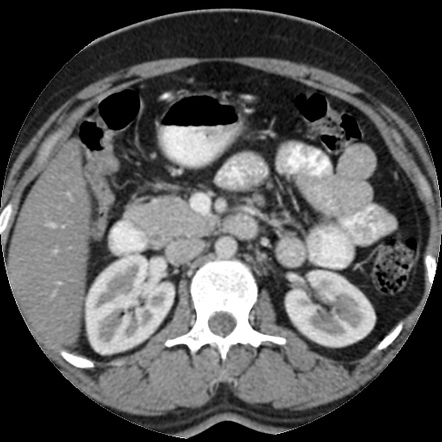 Dorsal pancreatic agenesis | Radiology Case | Radiopaedia.org