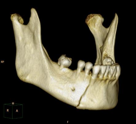 Types Of Mandibular Fractures