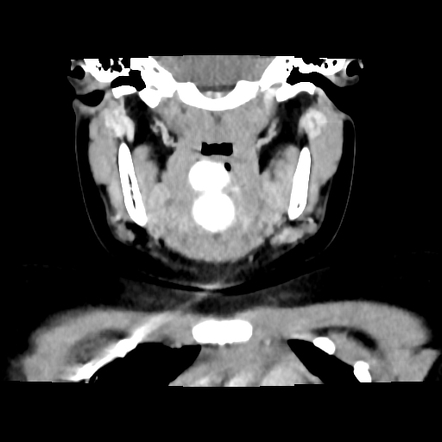 Lingual thyroid | Image | Radiopaedia.org