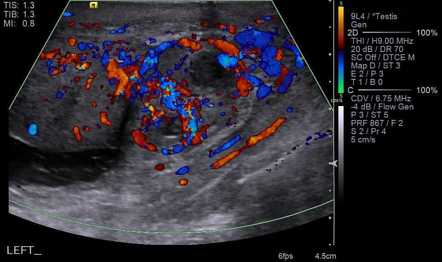 Epididymal Abscess Ultrasound