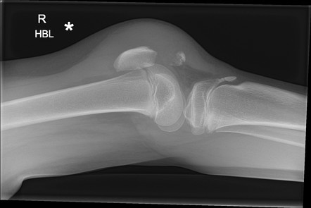 Patellar Fracture Radiology Case Radiopaedia Org