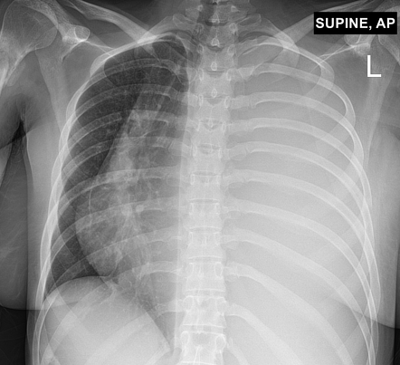 Incidental pathological humeral fracture on CXR | Radiology Case ...