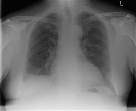 Multiple myeloma | Radiology Case | Radiopaedia.org