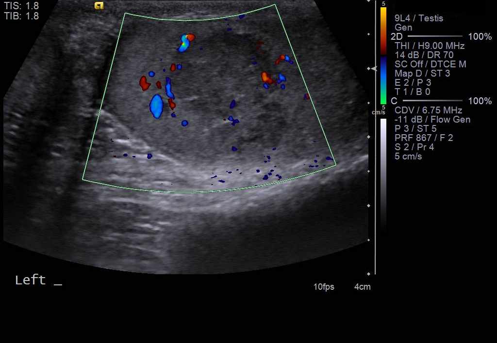 Testicular Seminoma Ultrasound