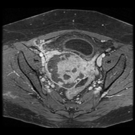 Pelvic actinomycosis infection | Radiology Case | Radiopaedia.org