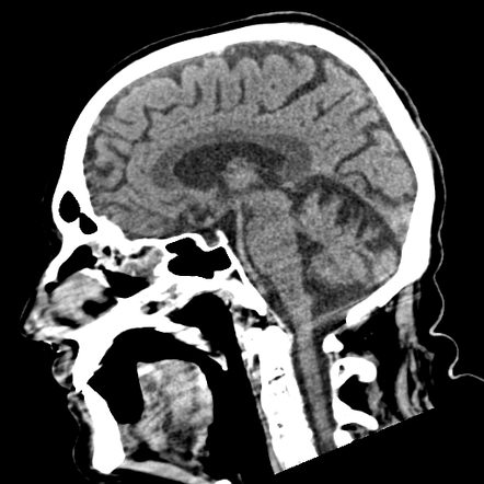 Marchiafava-Bignami disease | Radiology Reference Article | Radiopaedia.org