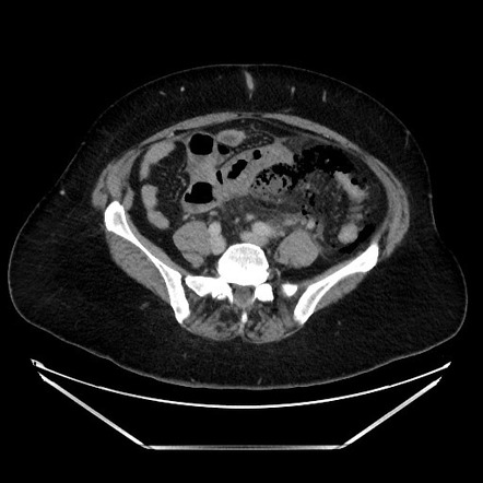 Perforated sigmoid diverticulitis with abscess, pneumoretroperitoneum ...