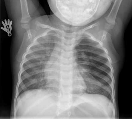 Congenital lobar overinflation | Radiology Reference Article ...