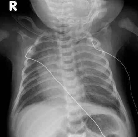 Congenital lobar overinflation | Radiology Case | Radiopaedia.org