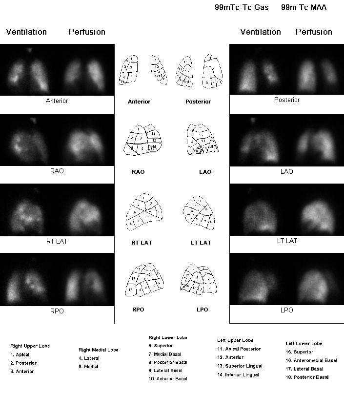 Bronchial obstruction (V/Q scan) | Image | Radiopaedia.org