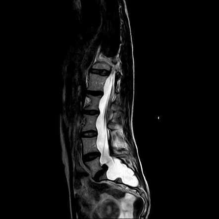 Dural ectasia in Marfan syndrome | Radiology Case | Radiopaedia.org