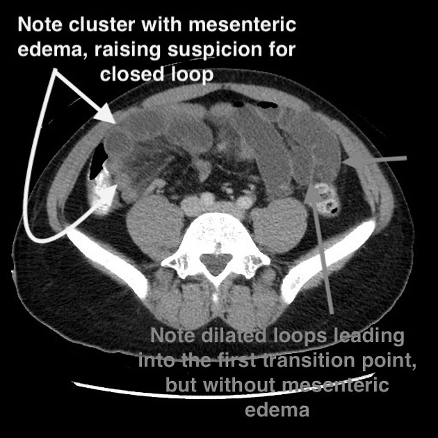 Closed loop small bowel obstruction Radiology Case Radiopaedia