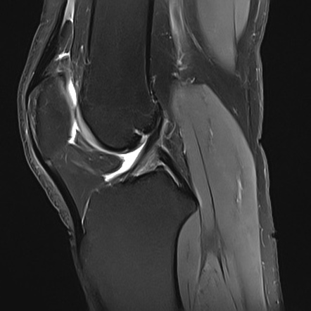 Partial seperation of prepatellar quadriceps continuation | Image ...