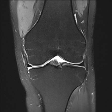 Partial seperation of prepatellar quadriceps continuation | Image ...