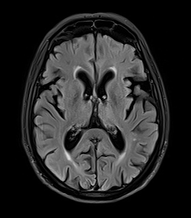 Progressive Supranuclear Palsy | Radiology Case | Radiopaedia.org