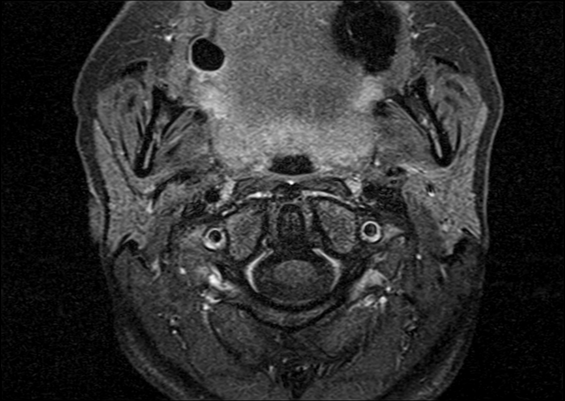 Pleomorphic adenoma - parotid gland | Image | Radiopaedia.org