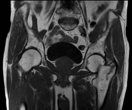 Nondisplaced incomplete intertrochanteric fracture | Radiology Case ...