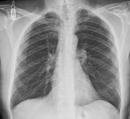 Fibrous dysplasia of the rib | Radiology Case | Radiopaedia.org