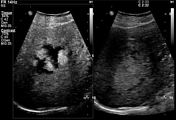 Hepatic hemangioma | Radiology Reference Article | Radiopaedia.org