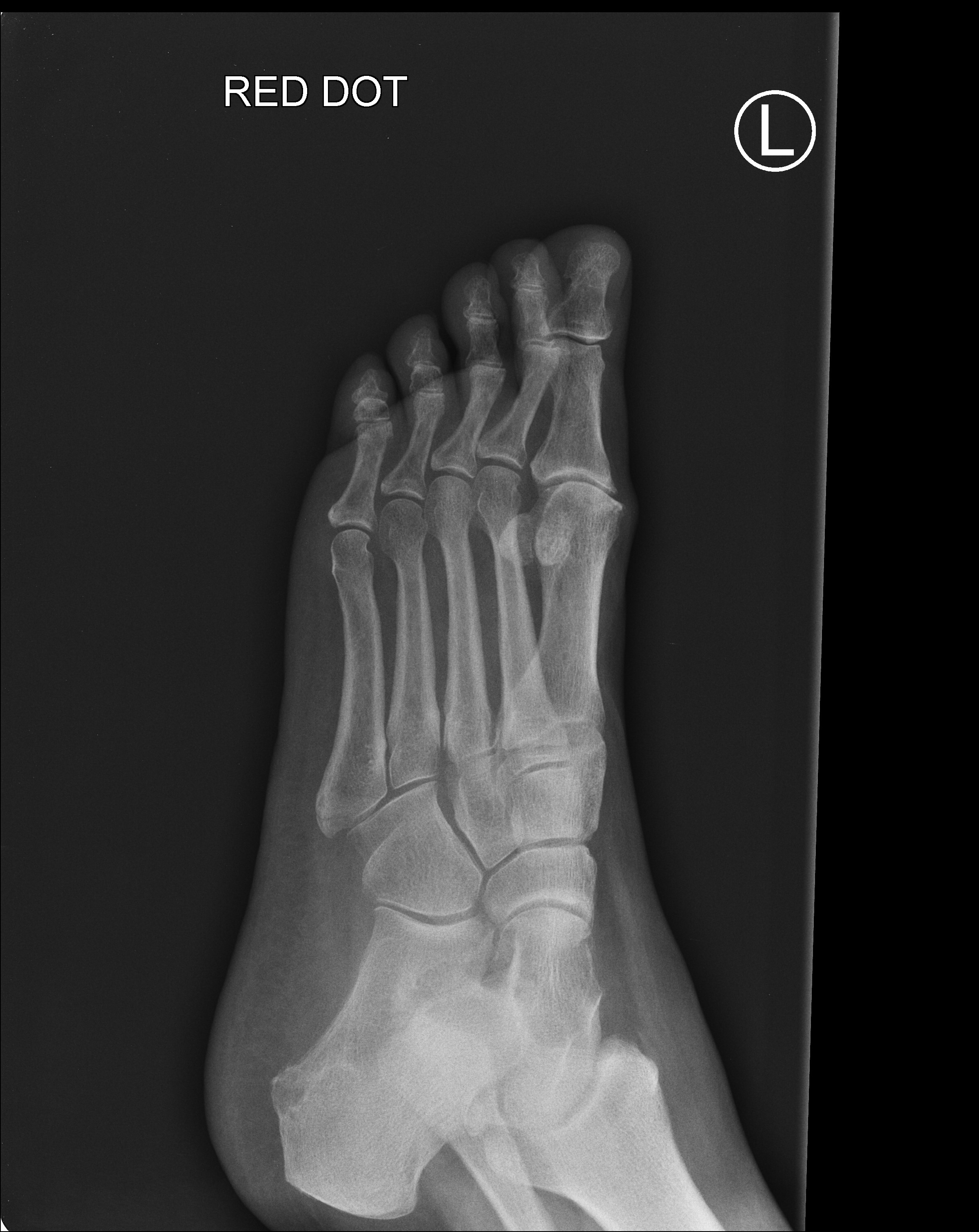 Base Of Fifth Metatarsal Fracture 