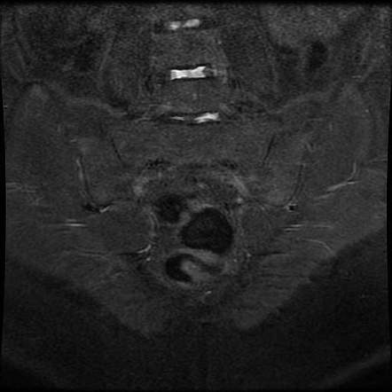 Chronic sacroiliitis | Image | Radiopaedia.org