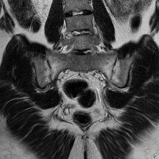 Chronic sacroiliitis | Image | Radiopaedia.org