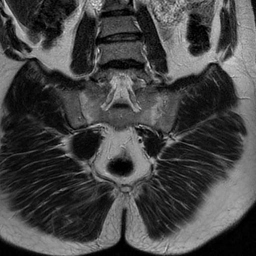 Chronic Sacroiliitis 