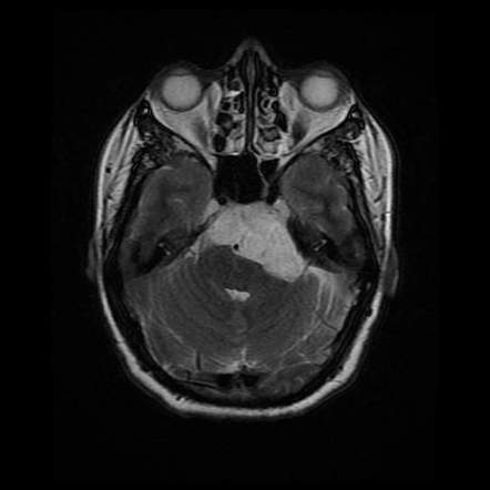 Cerebellopontine angle epidermoid cyst | Radiology Case | Radiopaedia.org