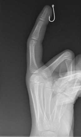 Fish hook in finger | Radiology Case | Radiopaedia.org