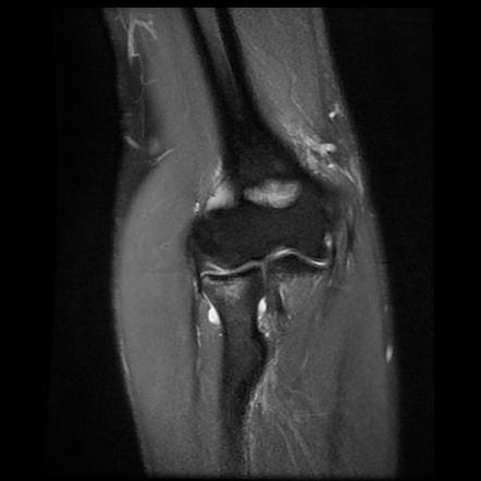 Radial head fracture | Image | Radiopaedia.org