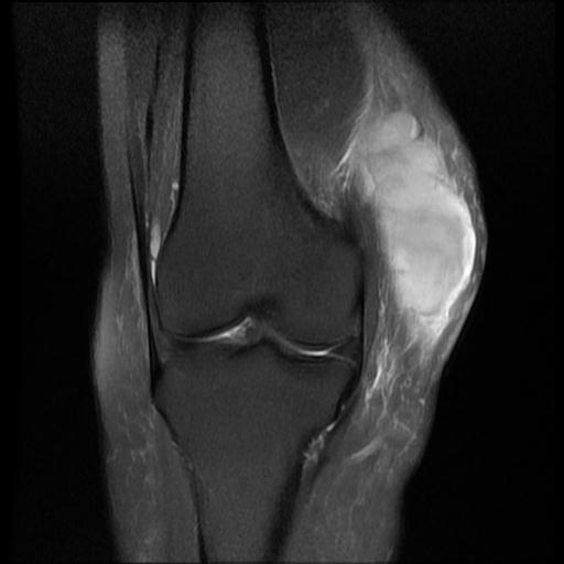 soft-tissue-hematoma-knee-image-radiopaedia