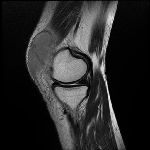 soft-tissue-hematoma-knee-image-radiopaedia