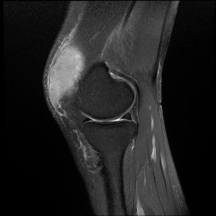 Soft tissue hematoma - knee | Image | Radiopaedia.org