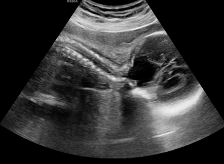 Dandy-Walker malformation - excessive Wharton jelly | Radiology Case