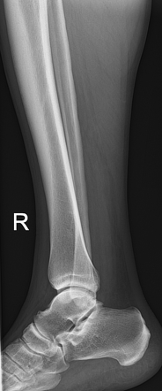 Medial tibial stress syndrome | Image | Radiopaedia.org