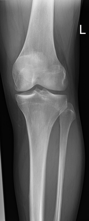 Medial tibial stress syndrome | Image | Radiopaedia.org