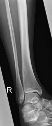 Medial tibial stress syndrome | Image | Radiopaedia.org