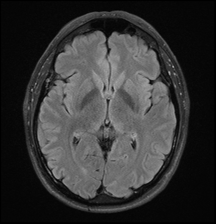 Glioblastoma - early | Image | Radiopaedia.org