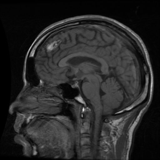 Dyke-Davidoff-Masson syndrome with mesial temporal sclerosis | Image ...