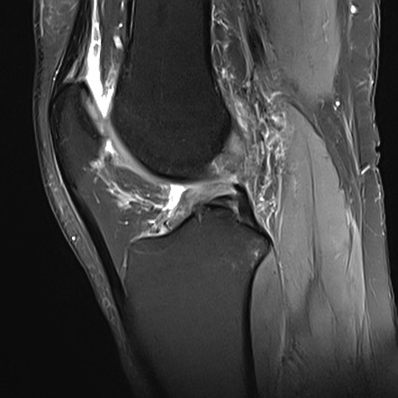 Pivot shift injury of knee-anterior cruciate ligament rupture ...