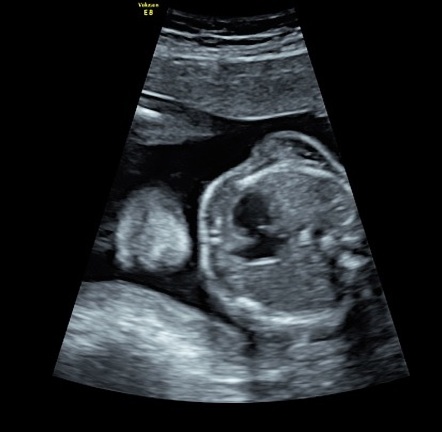 Hypoplastic left heart syndrome - antenatal | Radiology Case ...