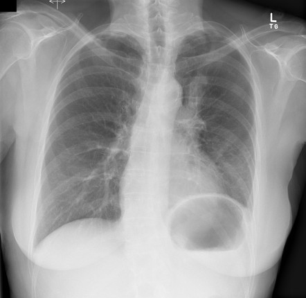 Lung Cancer | Radiology Reference Article | Radiopaedia.org