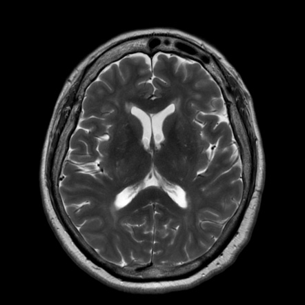 Anti-MOG encephalomyelitis | Image | Radiopaedia.org