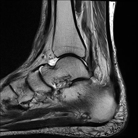 Rheumatoid arthritis | Image | Radiopaedia.org