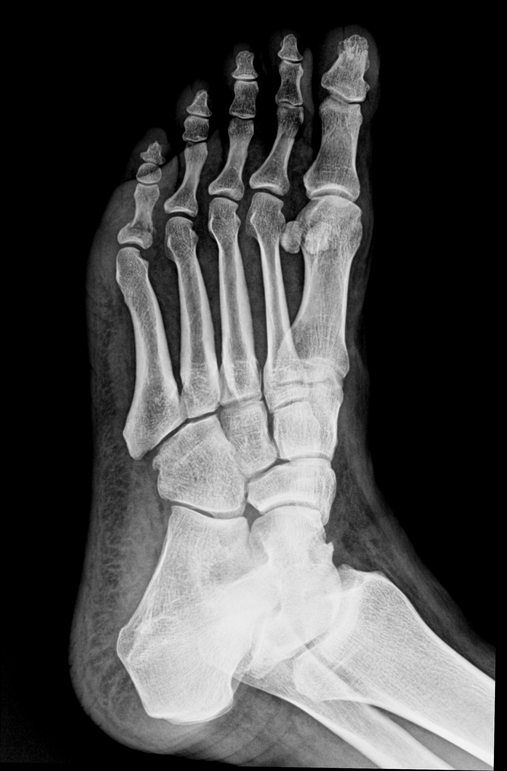 5th toe proximal phalanx fracture | Image | Radiopaedia.org