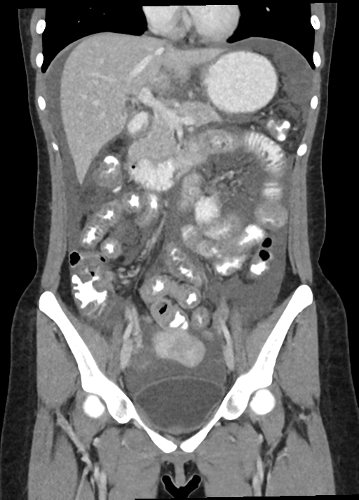 Eosinophilic Gastroenteritis Radiology Case 