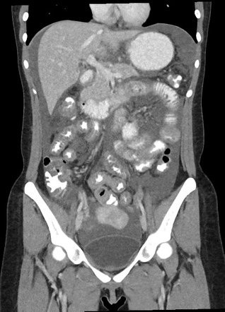 Eosinophilic Gastroenteritis 