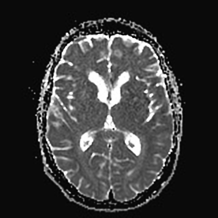 Remote cerebellar hemorrhage | Image | Radiopaedia.org