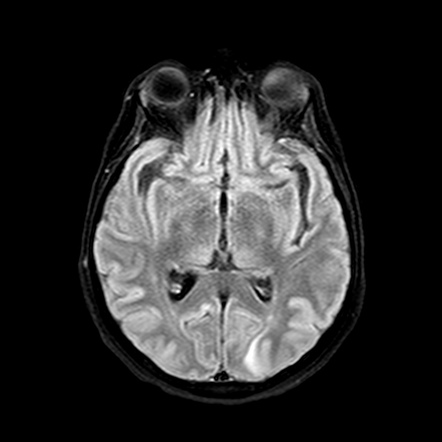 Pulvinar sign (CNS) | Radiology Reference Article | Radiopaedia.org