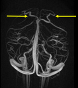 Nut für Sinus sagittalis superior